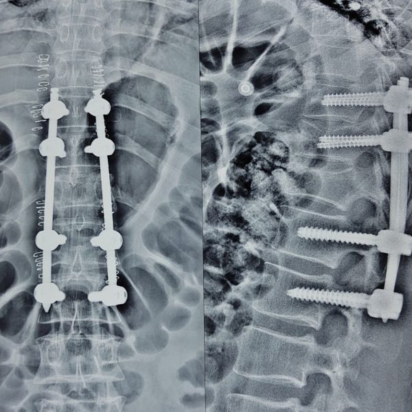 Spine Surgery | Dr. Shekhar Chirmade